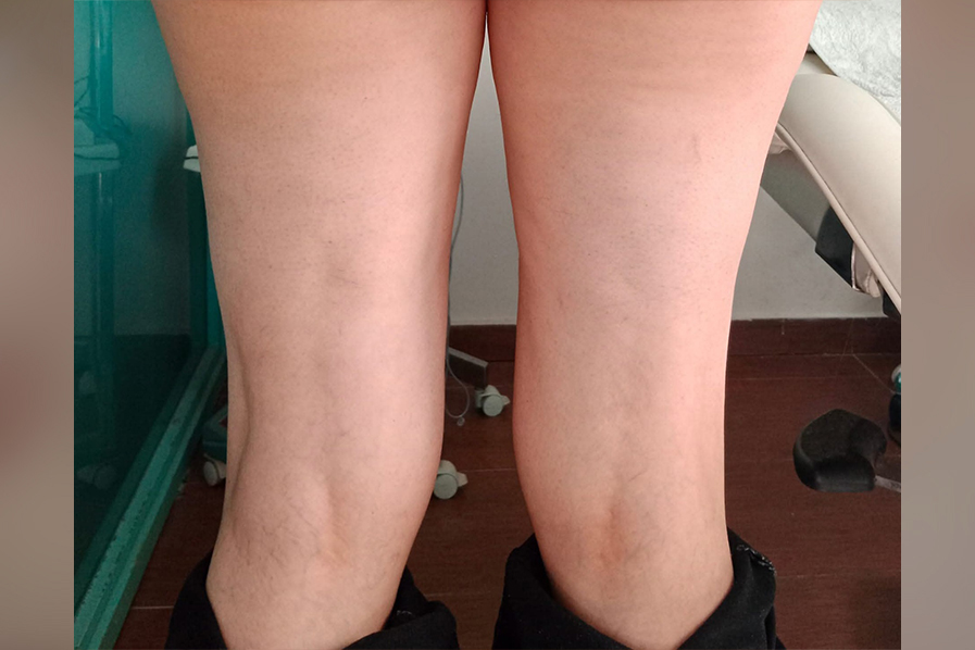 Cavitation RF Σύσφιξη