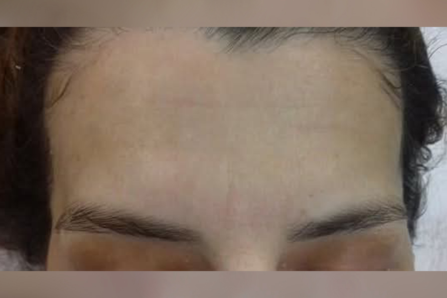 microneedling