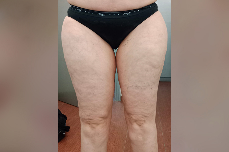 Cavitation RF Σύσφιξη