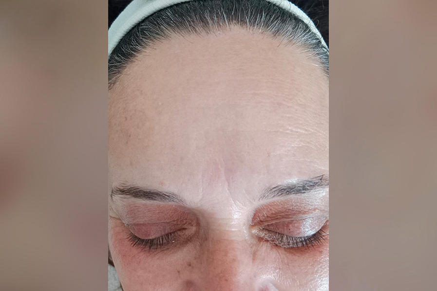 Microneedling