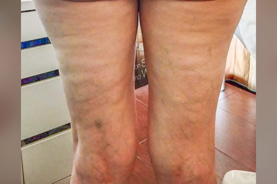 Cavitation RF Σύσφιξη