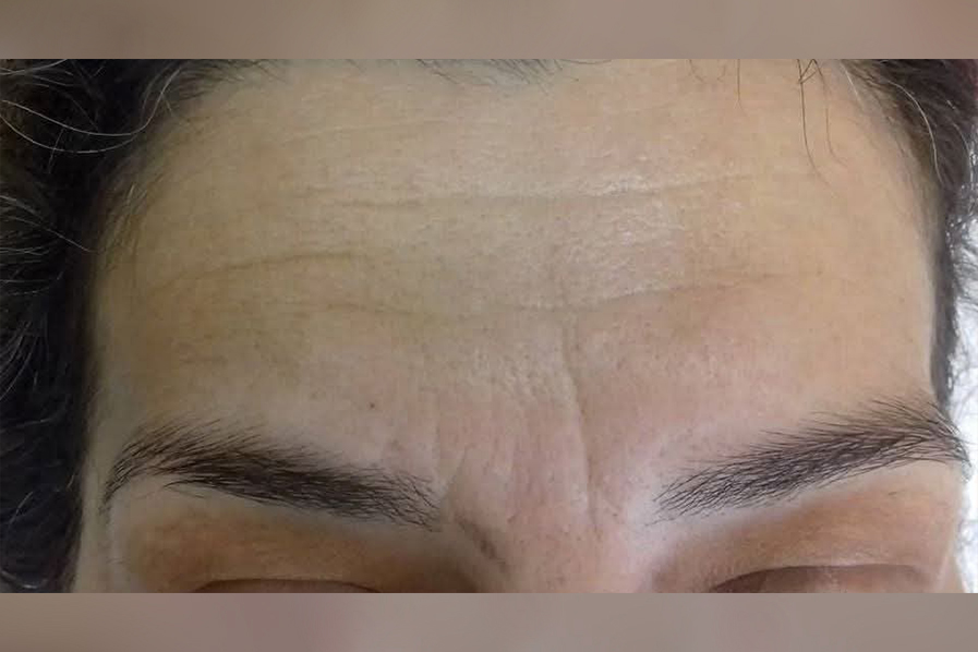 microneedling