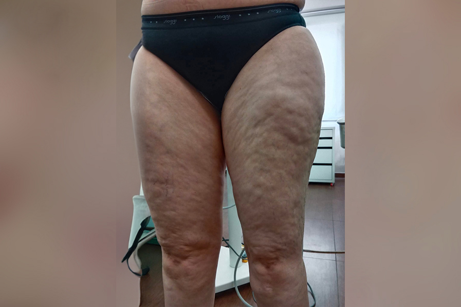 Cavitation RF Σύσφιξη