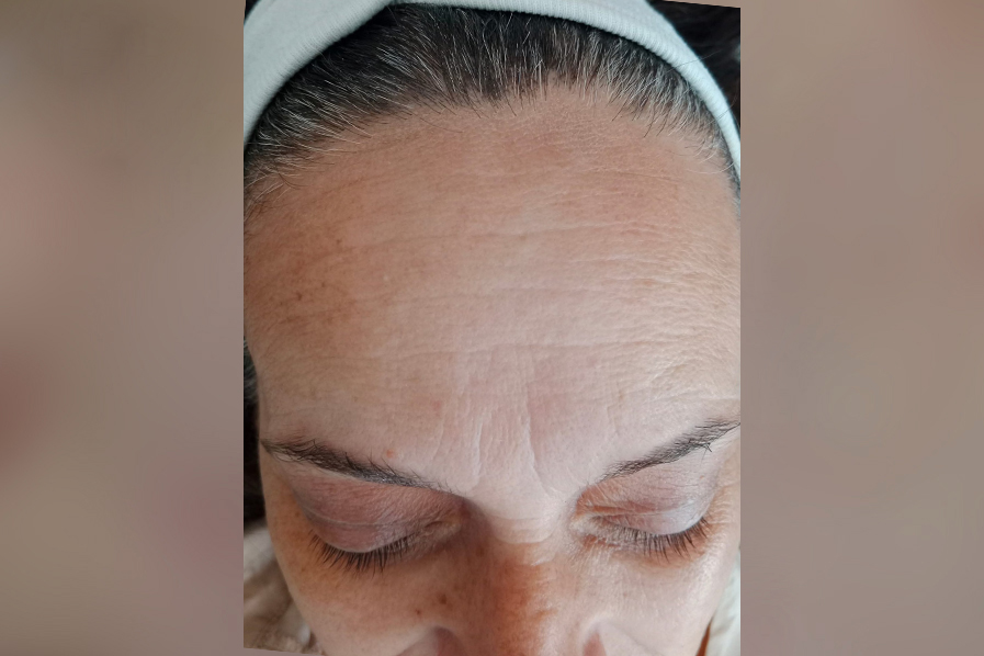 Microneedling